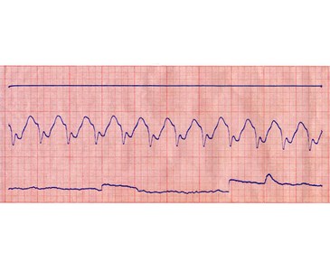 Terzo Inferiore - (Tracciato Reografico)